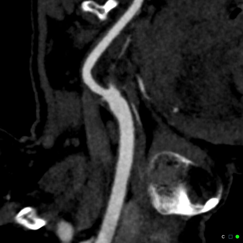 Non-occlusive intraluminal internal carotid artery thrombus (Radiopaedia 37751-39658 C 26).jpg