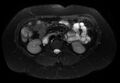Normal liver MRI with Gadolinium (Radiopaedia 58913-66163 Axial T2 fat sat 15).jpg