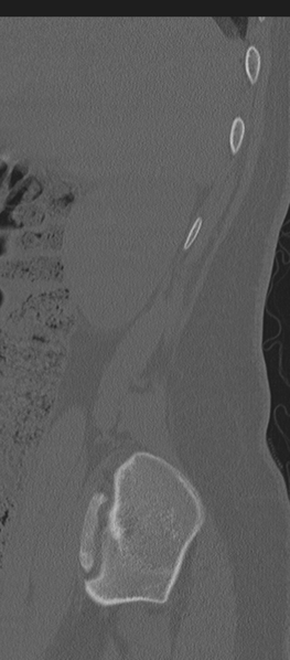 File:Normal lumbosacral CT (Radiopaedia 37923-39867 Sagittal bone window 91).png