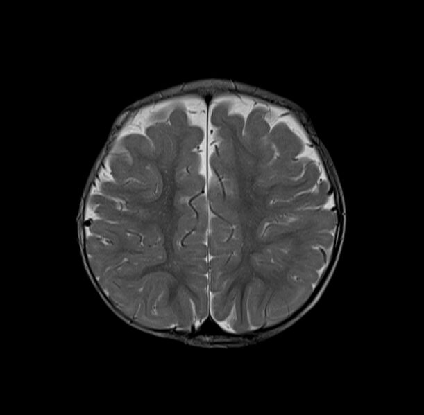 File:Normal myelination 19 month old (Radiopaedia 6813-7981 Axial T2 3).jpg