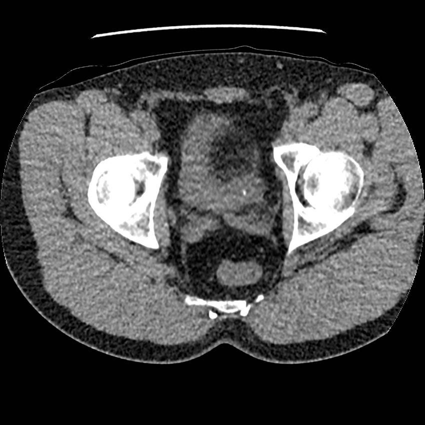 Obstructing ureteric calculus and ureteric anatomy (Radiopaedia 62730-71042 Axial non-contrast 158).jpg
