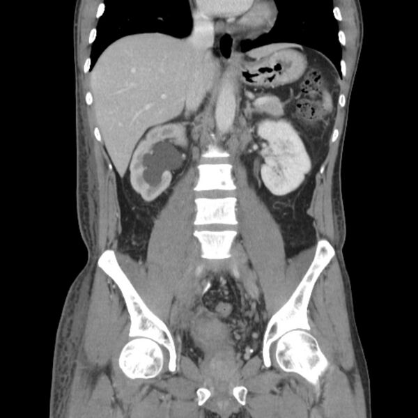 File:Obstructive bladder transitional cell carcinoma (Radiopaedia 9825-10410 B 13).jpg