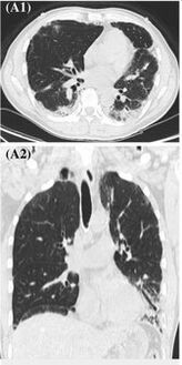 High-resolution computed tomography reveals patchy consolidation, ground-glass opacification in bilateral lower lungs