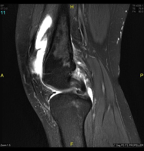 File:ACL mucoid degeration with cystic changes (Radiopaedia 48428-53341 Sagittal PD fat sat 9).jpg