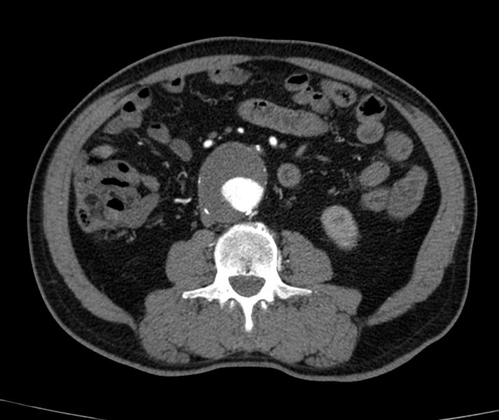 File:Abdominal aortic aneurysm (Radiopaedia 22421-22458 C+ arterial phase 47).jpg