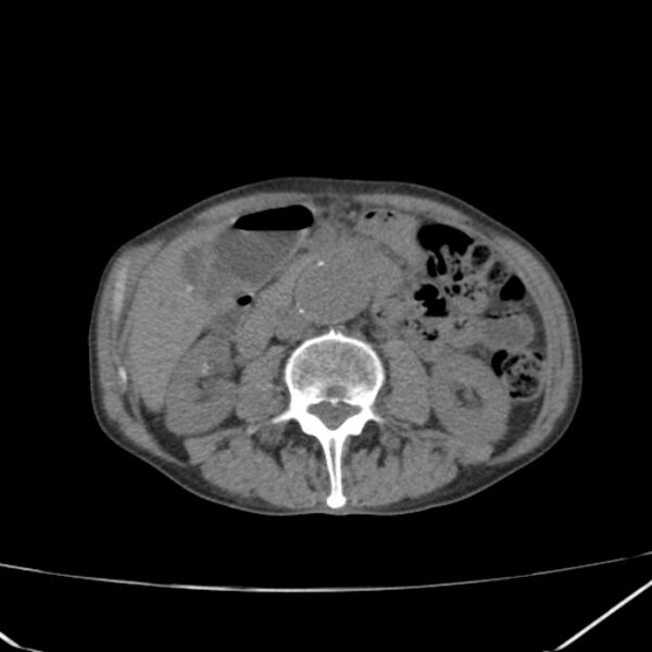 File:Abdominal aortic aneurysm (Radiopaedia 23703-23856 Axial non-contrast 25).jpg