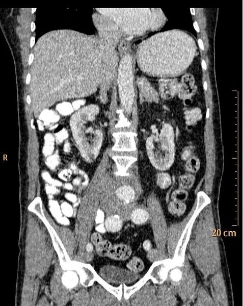 File:Abdominal aortic aneurysm (Radiopaedia 25985-26121 Coronal C+ arterial phase 20).jpg