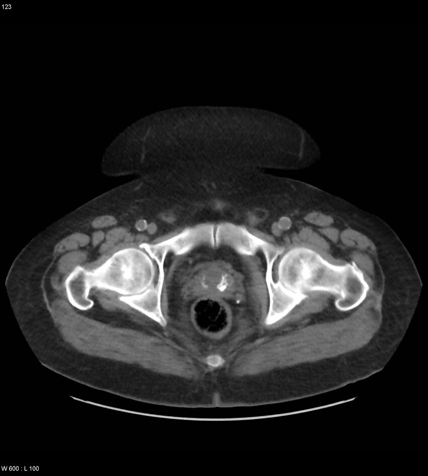 Abdominal aortic aneurysm with intramural hematoma then rupture (Radiopaedia 50278-55631 Axial non-contrast 119).jpg