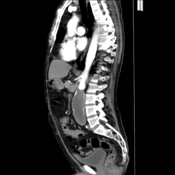 File:Abdominal aortic interposition tube graft and aneurysm thrombosis (Radiopaedia 71438-81857 Sagittal C+ arterial phase 15).jpg