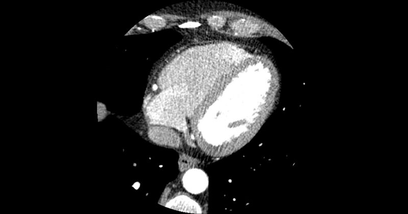 File:Aberrant left main coronary artery (ALMCA) arising from the right sinus with interarterial course (Radiopaedia 63251-71814 Axial C+ arterial phase 147).JPG