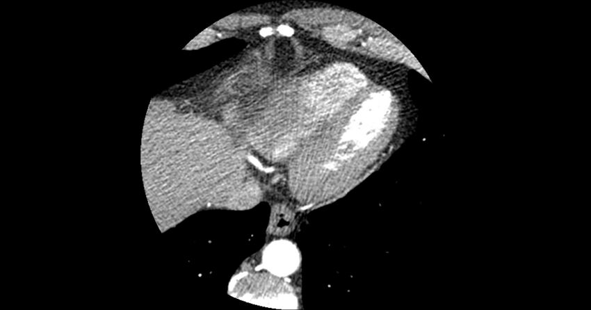 Aberrant left main coronary artery (ALMCA) arising from the right sinus with interarterial course (Radiopaedia 63251-71814 Axial C+ arterial phase 171).JPG