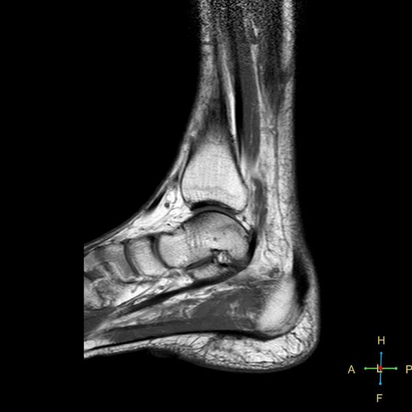 File:Achilles tendon complete tear (Radiopaedia 22834-22854 Sagittal T1 12).jpg