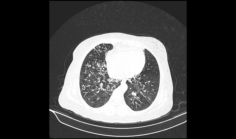 File:Acquired tracheo-esophageal fistula (Radiopaedia 51356-57103 Axial lung window 31).jpg