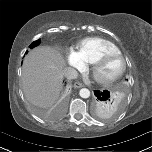 File:Acute-on-chronic pulmonary emboli (Radiopaedia 27925-28169 C+ CTPA 62).jpg