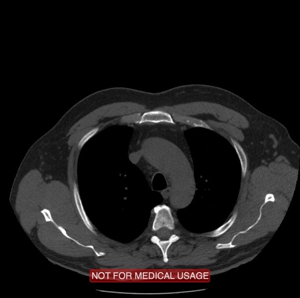 File:Acute aortic dissection - Stanford type A (Radiopaedia 40661-43285 Axial non-contrast 4).jpg