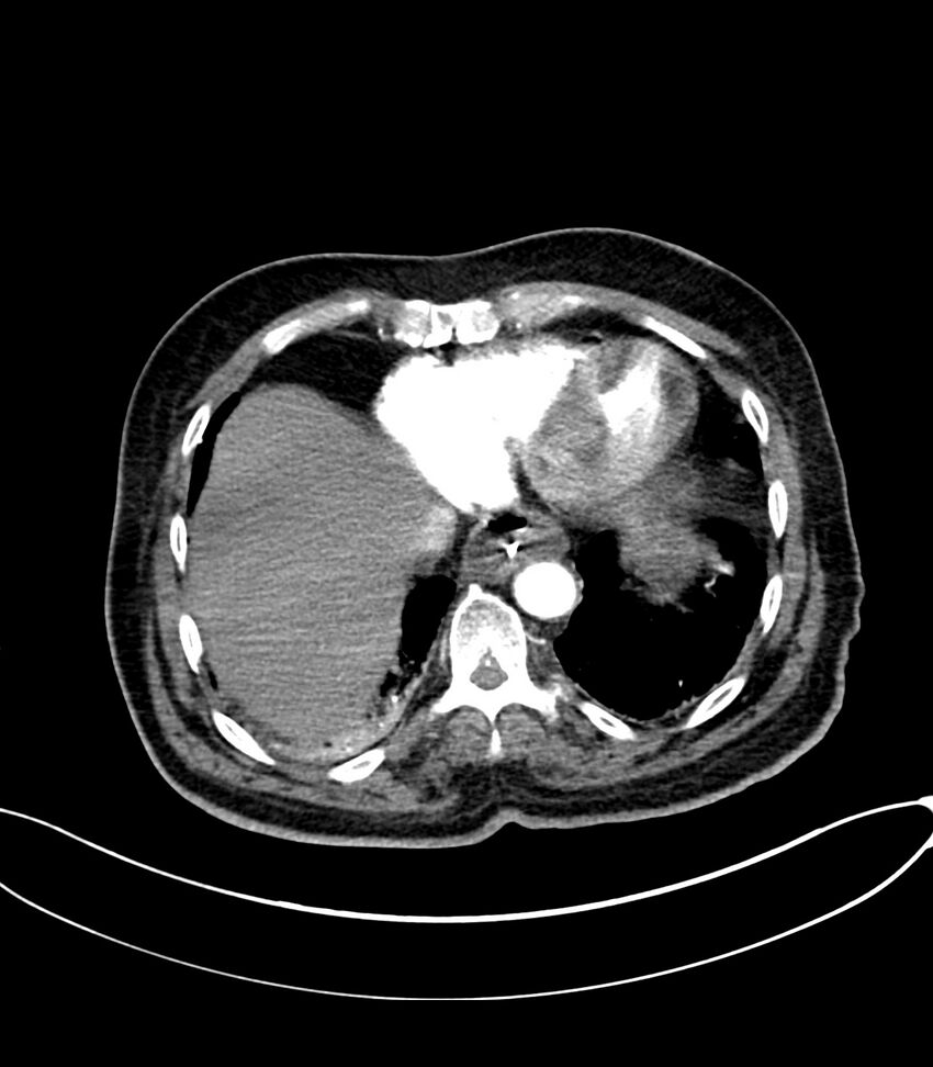 Acute arterial mesenteric ischemia (Radiopaedia 78238-90828 Axial C+ arterial phase 20).jpg