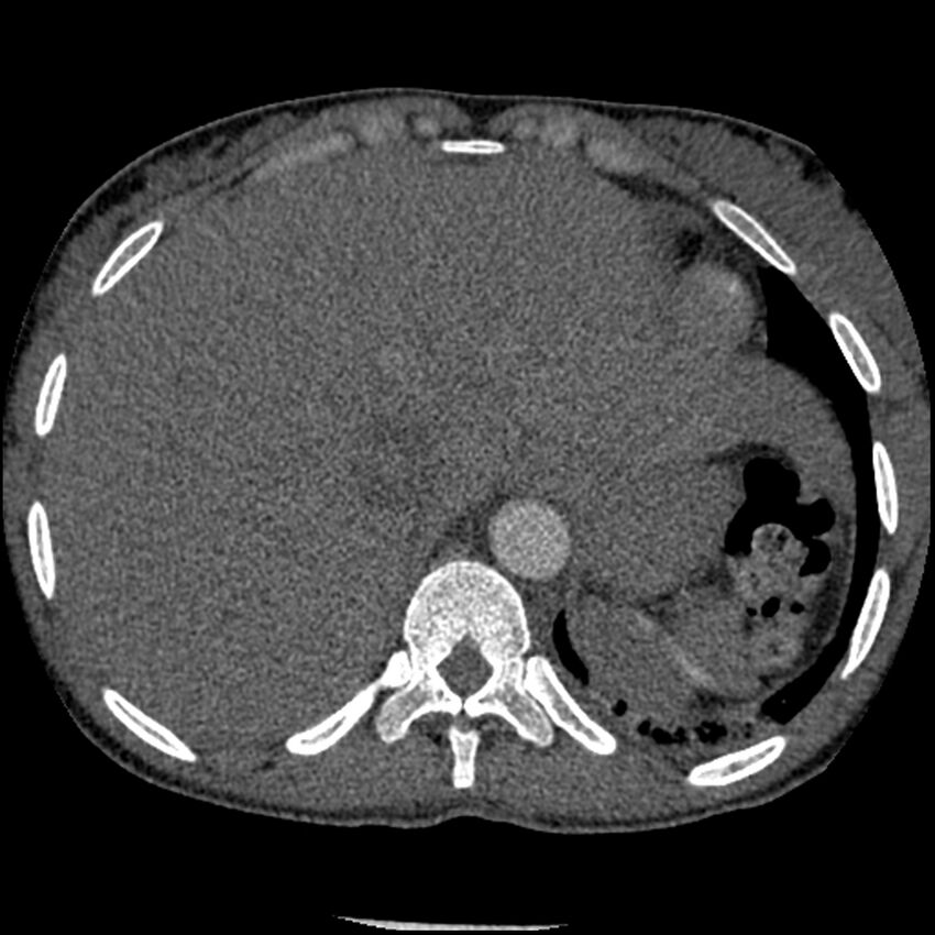 Acute chest syndrome - sickle cell disease (Radiopaedia 42375-45499 Axial C+ CTPA 168).jpg