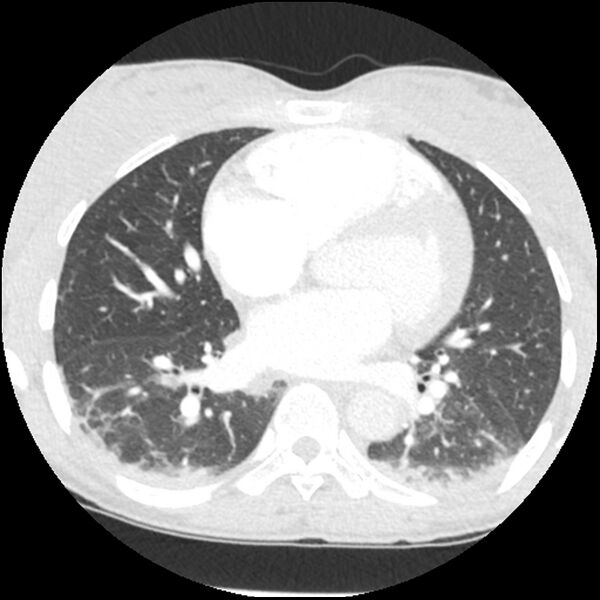 File:Acute chest syndrome - sickle cell disease (Radiopaedia 42375-45499 Axial lung window 110).jpg
