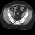 Acute cholecystitis and ureteric colic (Radiopaedia 42330-45444 Axial prone 88).jpg