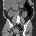 Acute cholecystitis and ureteric colic (Radiopaedia 42330-45444 Coronal prone 60).jpg