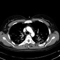 Acute myocardial infarction in CT (Radiopaedia 39947-42415 Axial C+ arterial phase 41).jpg