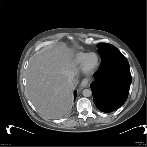 File:Acute pancreatitis (Radiopaedia 19135-19116 Axial non-contrast 3).jpg