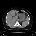 Acute pancreatitis - Balthazar C (Radiopaedia 26569-26714 Axial non-contrast 26).jpg