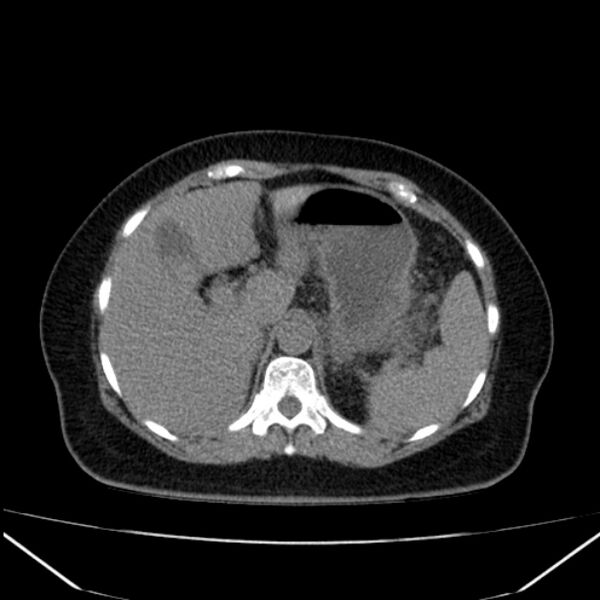 File:Acute pancreatitis - Balthazar C (Radiopaedia 26569-26714 Axial non-contrast 26).jpg