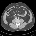 Acute pancreatitis - mild (Radiopaedia 27796-28033 C+ portal venous phase 35).jpg