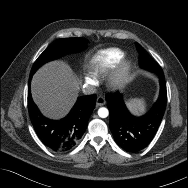 File:Acute pulmonary embolism with pulmonary infarct (Radiopaedia 73062-83768 Axial C+ CTPA 59).jpg