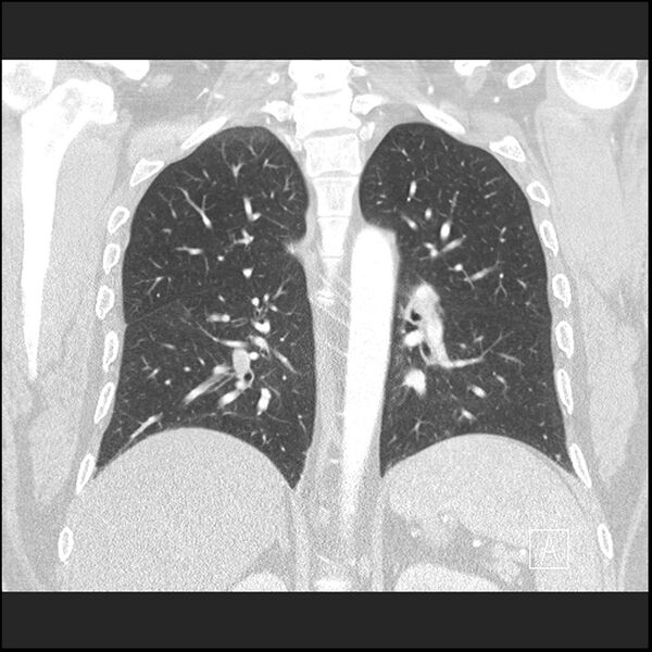 File:Acute pulmonary embolism with pulmonary infarct (Radiopaedia 73062-83768 Coronal lung window 49).jpg
