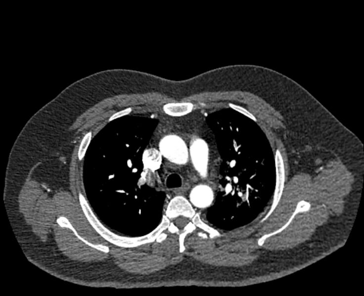 File:Acute pulmonary embolism with pulmonary infarcts (Radiopaedia 77688-89908 Axial C+ CTPA 19).jpg