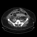 Acute pyelonephritis (Radiopaedia 25657-25837 Axial renal parenchymal phase 57).jpg
