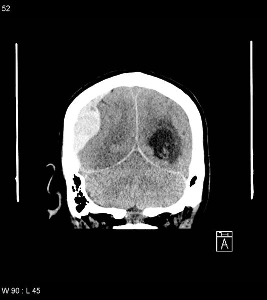 File:Acute subdural hematoma with myelofibrosis (Radiopaedia 52582-58494 Coronal non-contrast 43).jpg