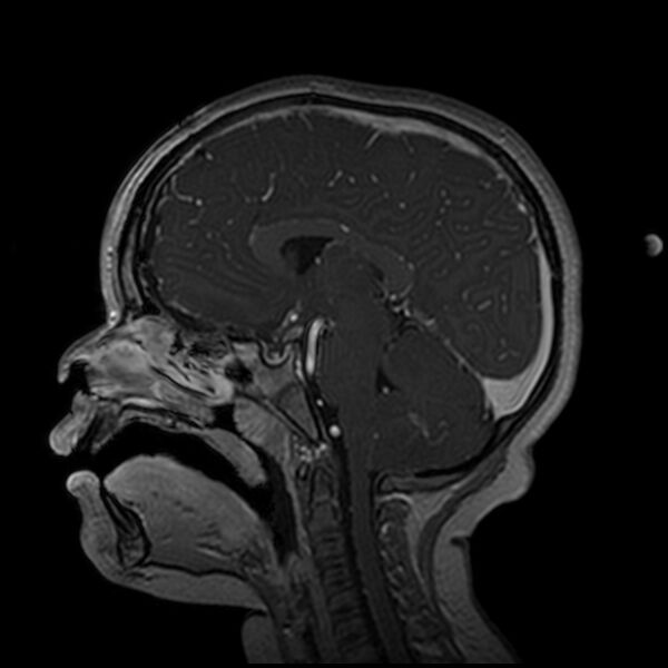 File:Adamantinomatous craniopharyngioma (Radiopaedia 77407-89529 H 64).jpg