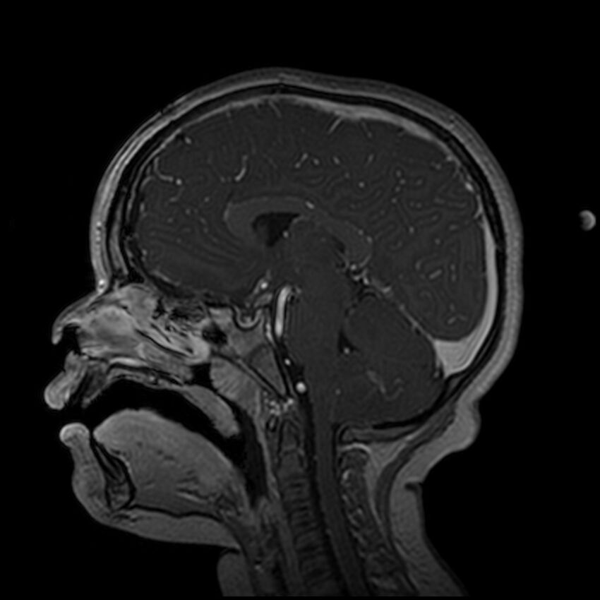 Adamantinomatous craniopharyngioma (Radiopaedia 77407-89529 H 64).jpg