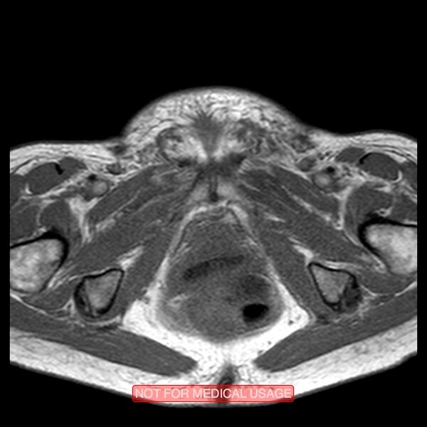 File:Adenocarcinoma of the cervix (Radiopaedia 28373-28615 Axial T1 3).jpg