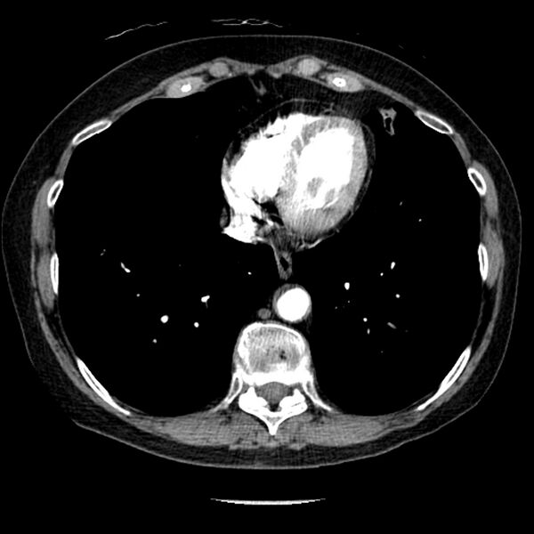 File:Adenocarcinoma of the lung (Radiopaedia 41015-43755 Axial C+ portal venous phase 89).jpg