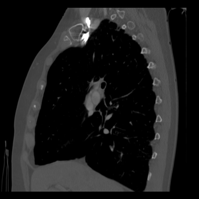 Adenocarcinoma of the lung (Radiopaedia 41015-43755 Sagittal bone window 40).jpg