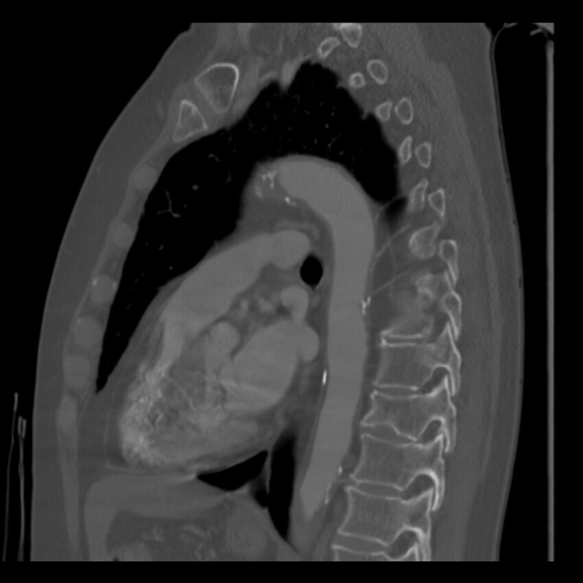 Adenocarcinoma of the lung (Radiopaedia 41015-43755 Sagittal bone window 61).jpg