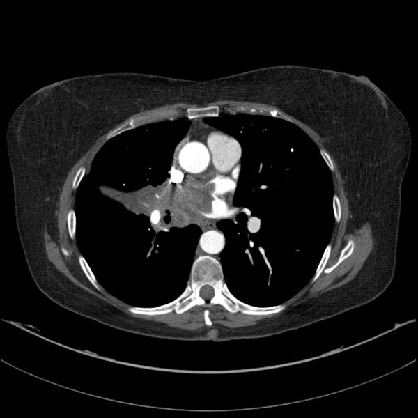 File:Adenocarcinoma of the lung (Radiopaedia 44205-47803 Axial C+ portal venous phase 44).jpg