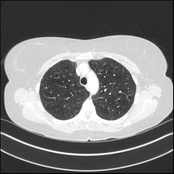 File:Adenocarcinoma of the lung (Radiopaedia 44205-47803 Axial lung window 27).jpg