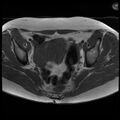 Adenoma malignum of the cervix (Radiopaedia 24460-24765 T1 9).jpg