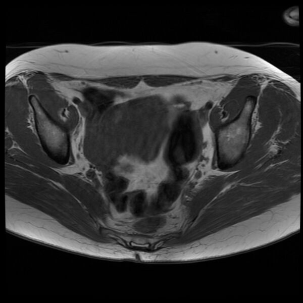 File:Adenoma malignum of the cervix (Radiopaedia 24460-24765 T1 9).jpg