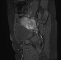 Adenomyosis - ovarian endometriomas (Radiopaedia 67031-76350 Sagittal T1 C+ fat sat 21).jpg