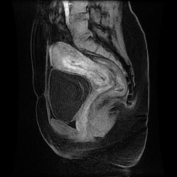 File:Adenomyosis within a septate uterus (Radiopaedia 69963-79981 Sagittal LAVA-Dyn 18).jpg