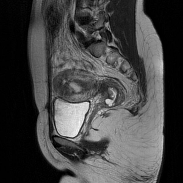 File:Adenomyosis within a septate uterus (Radiopaedia 69963-79981 Sagittal T2 19).jpg