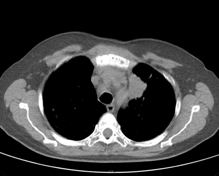 File:Adenosquamous lung carcinoma (Radiopaedia 22035-22030 non-contrast 21).jpg