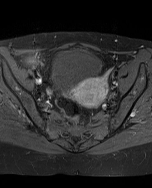 File:Adult granulosa cell tumor of the ovary (Radiopaedia 71581-81950 Axial T1 C+ fat sat 13).jpg