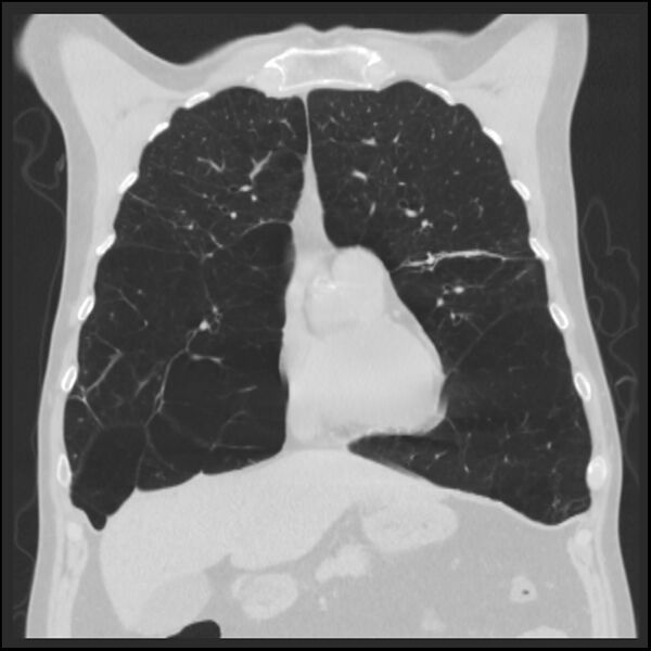 File:Alpha-1-antitrypsin deficiency (Radiopaedia 40993-43722 Coronal lung window 30).jpg